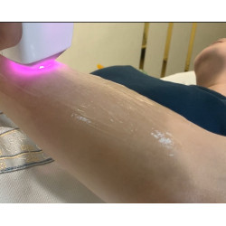 Epiliacijos diodo lazeris 808 nm