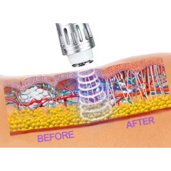 Smūginės, vibracinės bangos terapijos aparatas