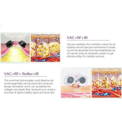 Velashape 3 Vakuumo aparatas 4-1