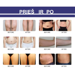 Velashape 3 Vakuumo aparatas 4-1