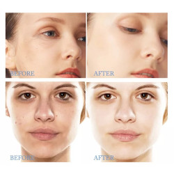 Velashape vakuumo lazerio aparatas 5-1