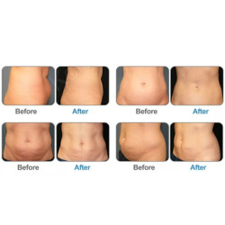 Krioterapijos kriolipolizės RF Lipo Lazerio aparatas