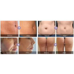 Velashape 3 vakuumo lazerio aparatas 6-1