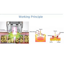 Velashape vakuumo lazerio aparatas 5-1