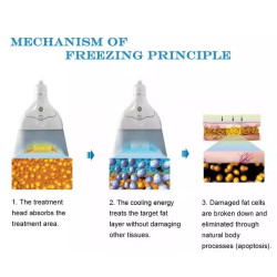 Krioterapijos kriolipolizės 360 aparatas
