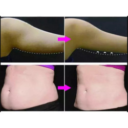 Krioterapijos kriolipolizės 360 aparatas