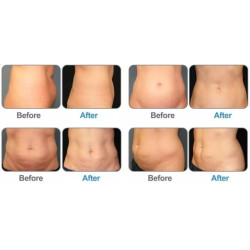 Krioterapijos kriolipolizės 360 aparatas