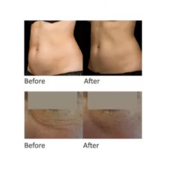 HIFU Veido Kūno ultragarsinis liposakcinis aparatas