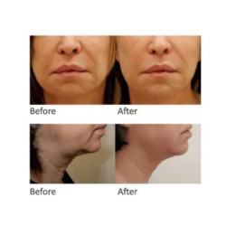 HIFU Veido Kūno ultragarsinis liposakcinis aparatas