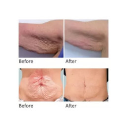 HIFU Veido Kūno ultragarsinis liposakcinis aparatas