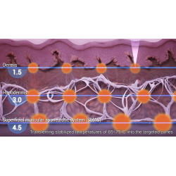 HIFU Veido Kūno ultragarsinis liposakcinis aparatas