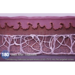 HIFU Veido Kūno ultragarsinis liposakcinis aparatas