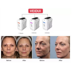 HIFU veido kūno liekninimo formavimo aparatas 3D