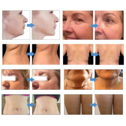 HIFU veido kūno liekninimo formavimo aparatas 7D