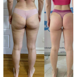 Ritininis kavitacijos  kuno veido masažuoklis