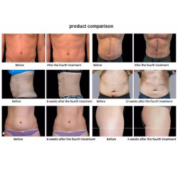 Riebalų pašalinimas ir kūno linijų formavimas