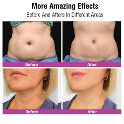 Veido kūno kontūravimo riebalų šalinimo RF aparatas