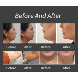 Veido kūno kontūravimo riebalų šalinimo RF aparatas