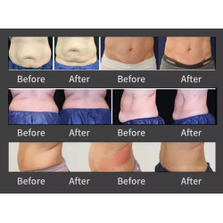 Veido kūno kontūravimo riebalų šalinimo RF aparatas