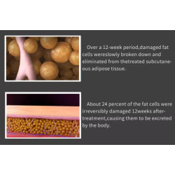 Veido kūno kontūravimo riebalų šalinimo RF aparatas