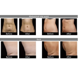 Lazerinis 1060 nm kūno lieknėjimo kontūravimo aparatas