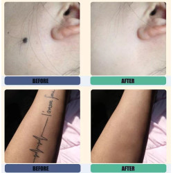 Pikosekundinis lazeris   532 755 1064 nm