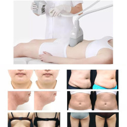 Krioterapijos kriolipolizės 360 aparatas