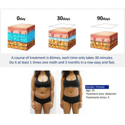 Kriolipolizės 4D aparatas