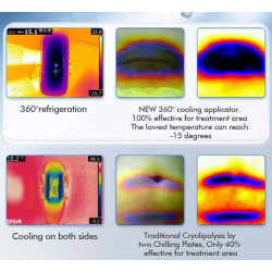 Kriolipolizės 4D aparatas