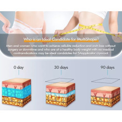 Kriolipolizės 4D aparatas