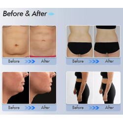 Kriolipolizės 4D aparatas