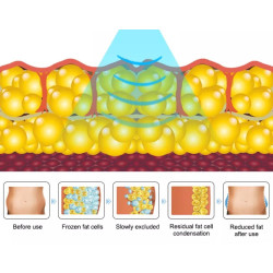 Velashape Cryo kavitacijos vakuumo mašina 2 in 1