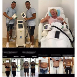 Krioterapijos kriolipolizės aparatas