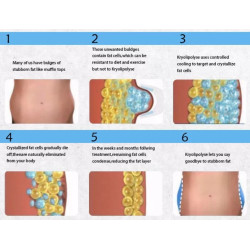 Krioterapijos kriolipolizės aparatas