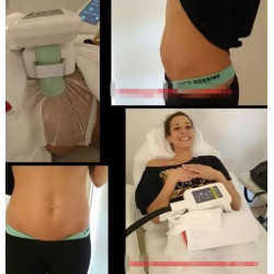 Krioterapijos kriolipolizės aparatas