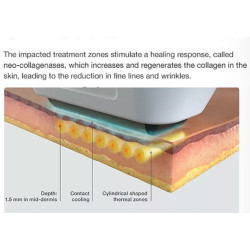 Raukšlių šalinimo ir odos atjauninimo Ultragarso RF aparatas