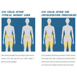 Krioterapijos kriolipolizės 4in1 kūno lieknėjimo aparatas