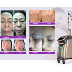 Pikosekundinis lazeris 1064 532 nm