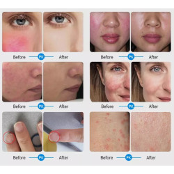 Diodinis lazeris 980nm kraujagyslių vorinių venų šalinimo aparatas  6-1