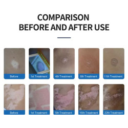 Psoriazės Vitiligo Eksimerinis 308nm lazeris