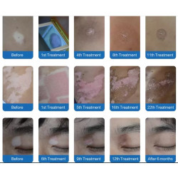 Psoriazės Vitiligo Eksimerinis 308nm lazeris