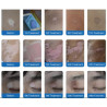 Psoriazės Vitiligo Eksimerinis 308nm lazeris