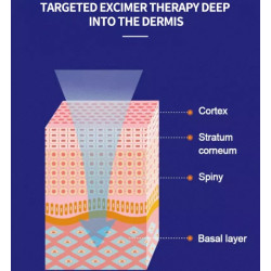 Psoriazės Vitiligo Eksimerinis 308nm lazeris