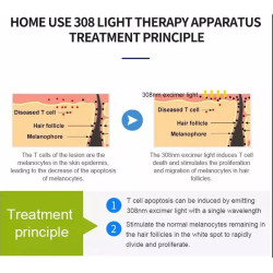 Psoriazės Vitiligo Eksimerinis 308nm lazeris
