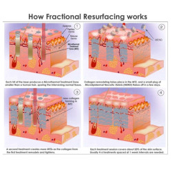 Frakcinis RF lazerinis veido atnaujinimui makšties stangrinimo aparatas