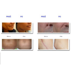 Frakcinis RF lazerinis veido atnaujinimui makšties stangrinimo aparatas