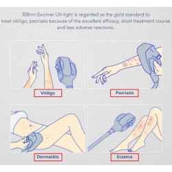 Psoriazės Vitiligo Eksimerinis 308nm lazeris