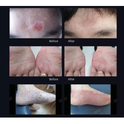 Psoriazės Vitiligo Eksimerinis 308nm lazeris