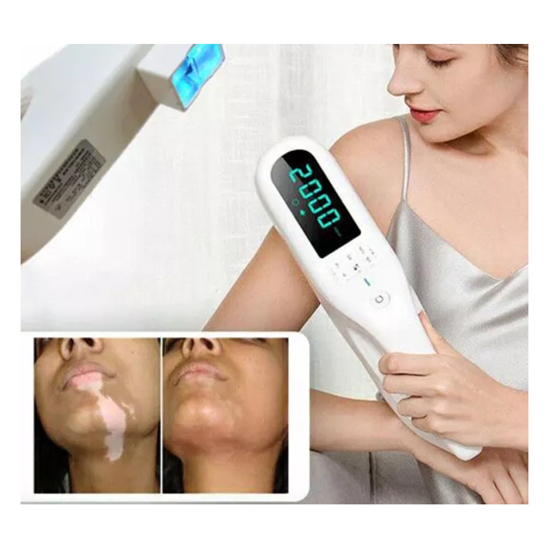 Psoriazės vitiligo psoriazės egzemos grybelinės mikozės eksimerinis 308nm lazeris UV lempa