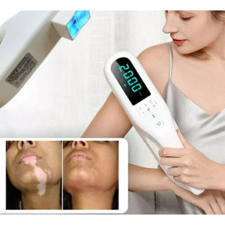 Psoriazės vitiligo psoriazės egzemos grybelinės mikozės eksimerinis 308nm lazeris UV lempa